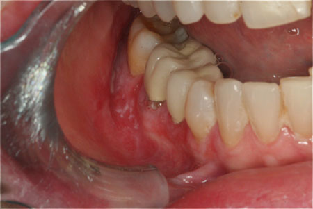 Gum White Sore