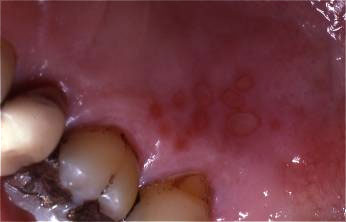 Herpes on roof of mouth deals