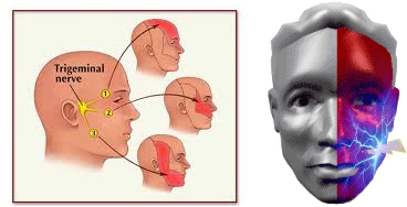 Image result for trigeminal pain